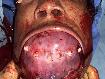 Removal of a mandibulectomy mass