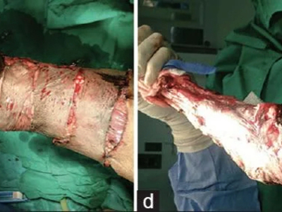 Avulsion amputation of left forearm