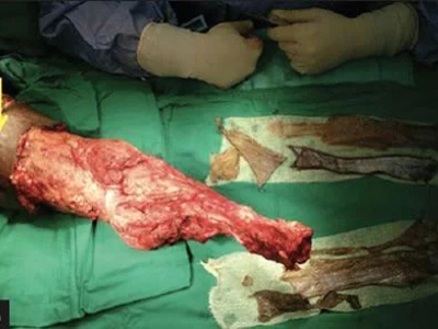 Avulsion amputation of left forearm