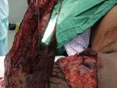 Avulsion amputation of left forearm