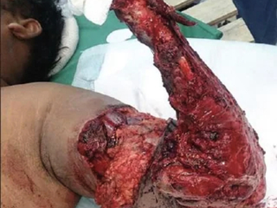 Avulsion amputation of left forearm