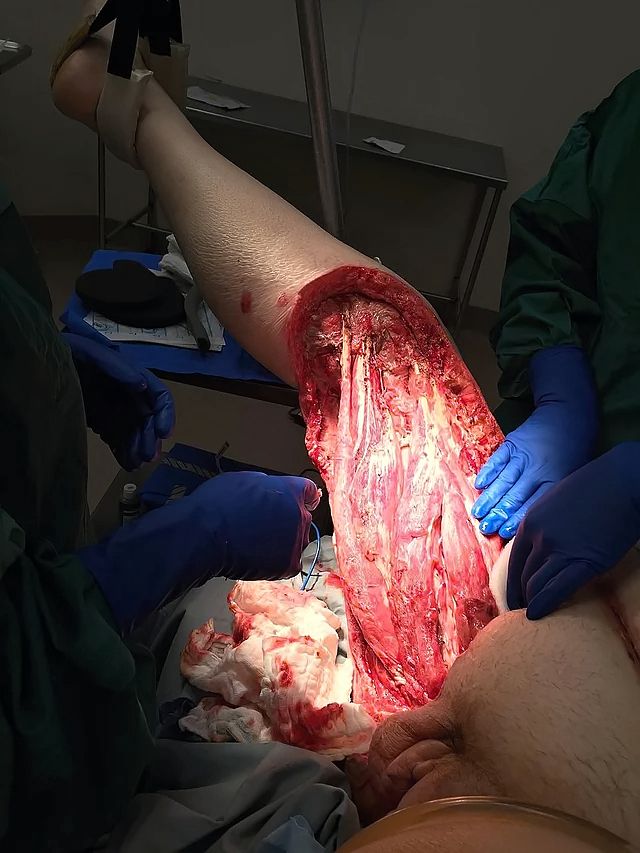 Necrotizing fasciitis of the right groin and upper inner thigh