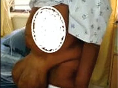 Giant pedunculated incisional hernia