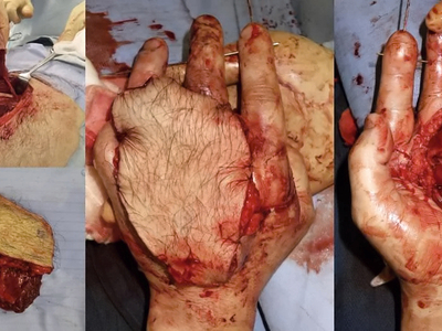 Reconstruction of hand after punching machine accident