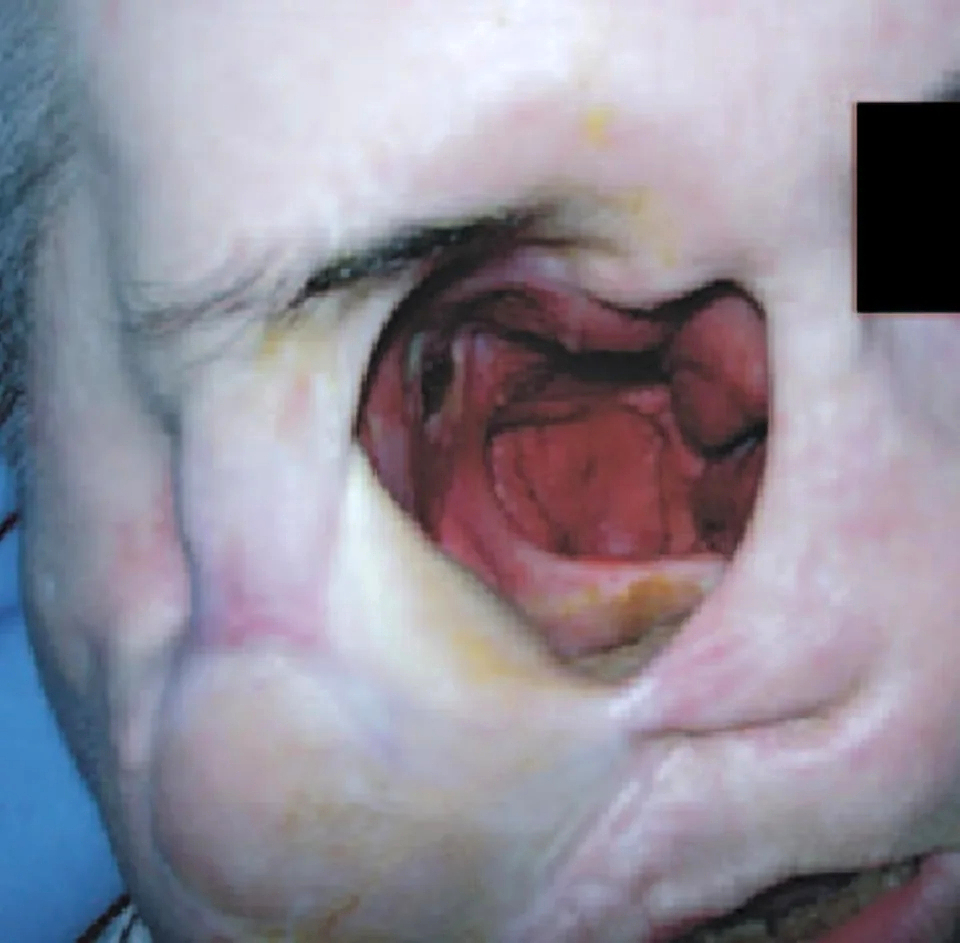 Fungal infection following tooth extraction