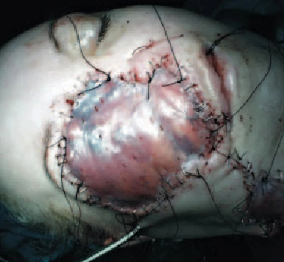 Fungal infection following tooth extraction