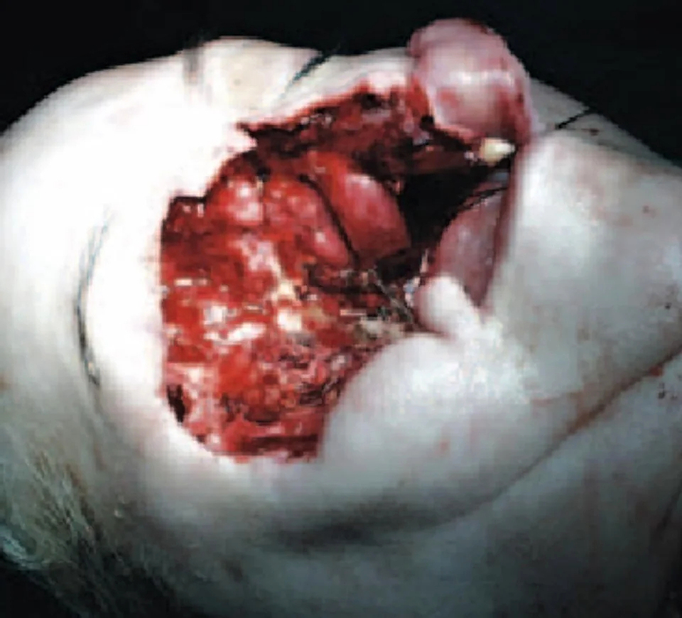 Fungal infection following tooth extraction