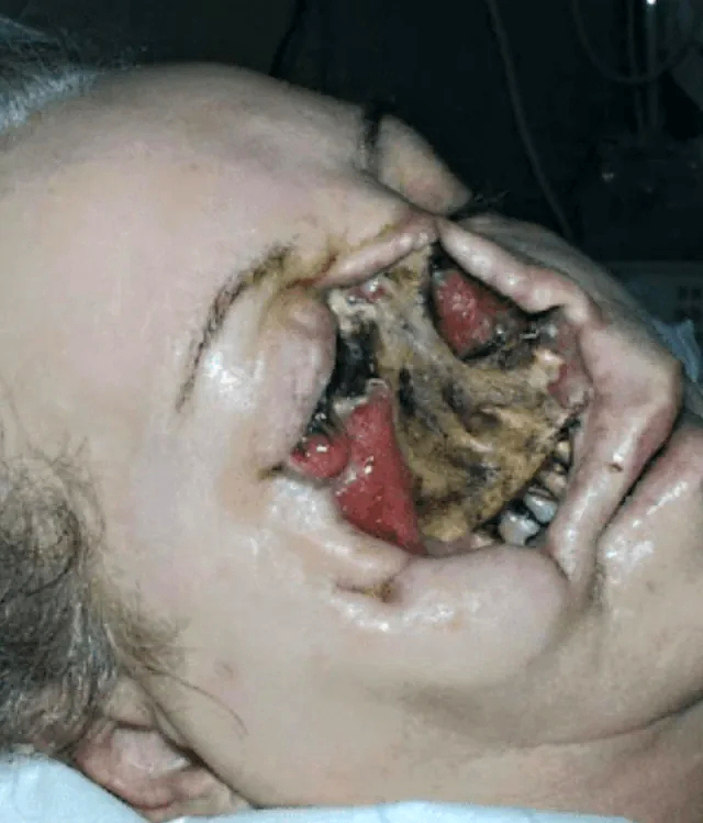 Fungal infection following tooth extraction