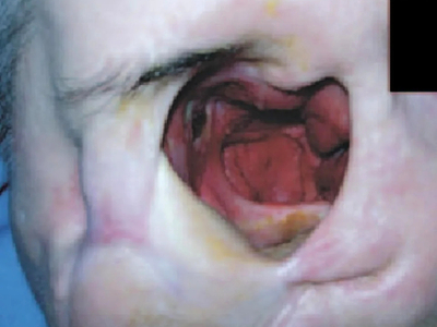 Fungal infection following tooth extraction