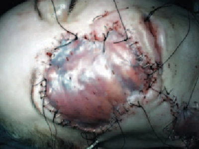 Fungal infection following tooth extraction