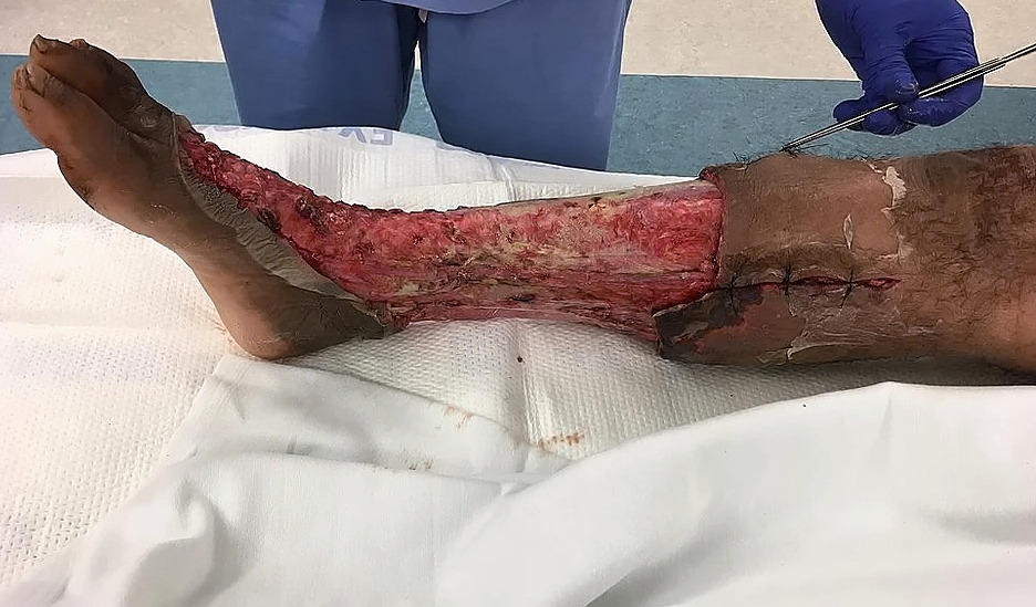 Necrotizing fasciitis of the leg