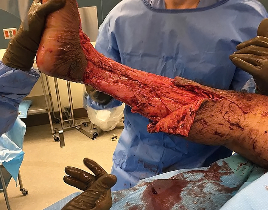 Necrotizing fasciitis of the leg