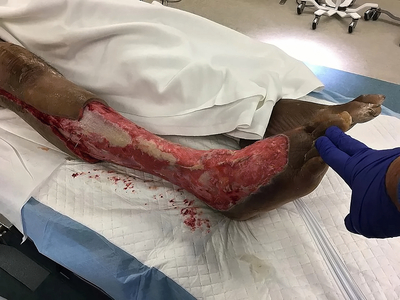 Necrotizing fasciitis of the leg