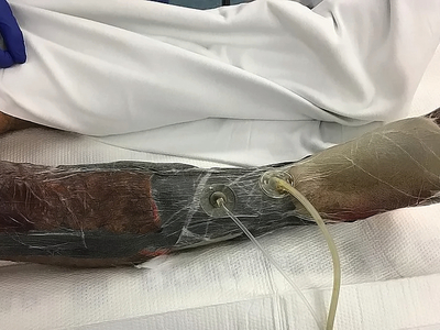 Necrotizing fasciitis of the leg