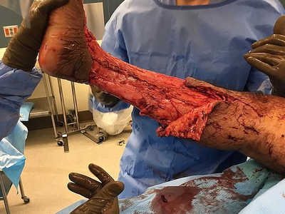 Necrotizing fasciitis of the leg