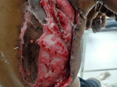 Extraskeletal Ewing sarcoma