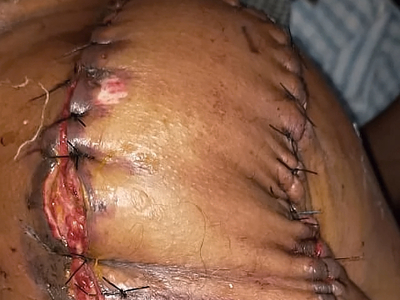 Extraskeletal Ewing sarcoma