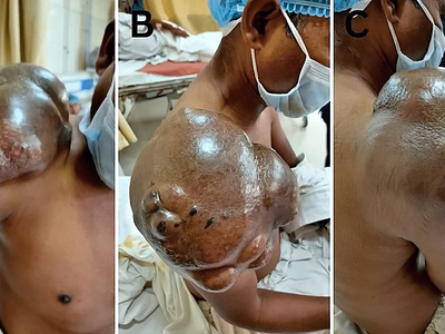 Extraskeletal Ewing sarcoma