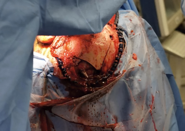 Self inflicted speargun injury to head