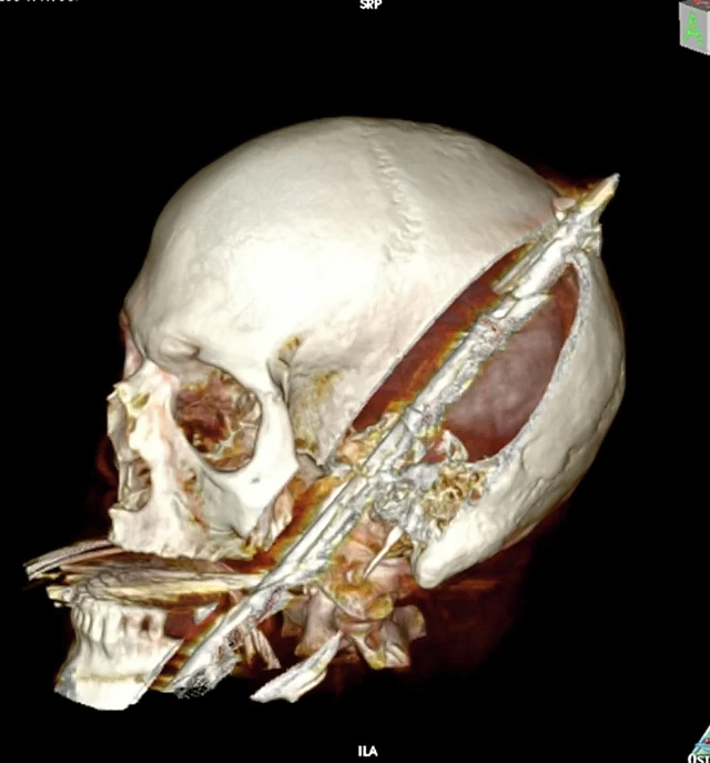 Self inflicted speargun injury to head