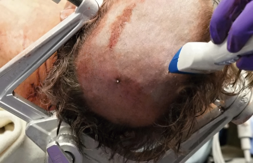 Self inflicted speargun injury to head