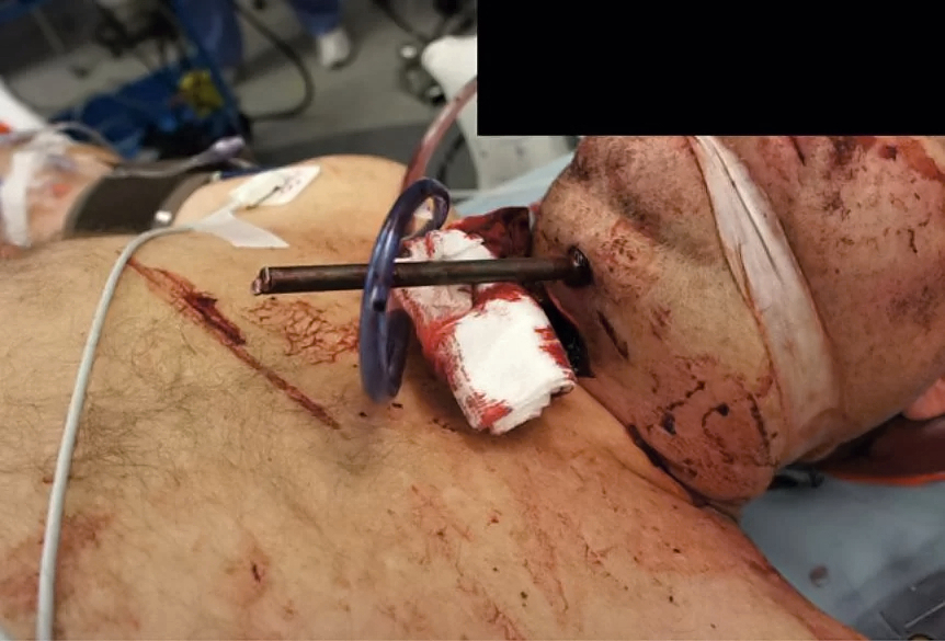 Self inflicted speargun injury to head