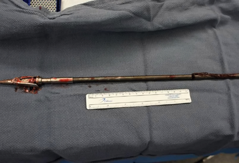 Self inflicted speargun injury to head