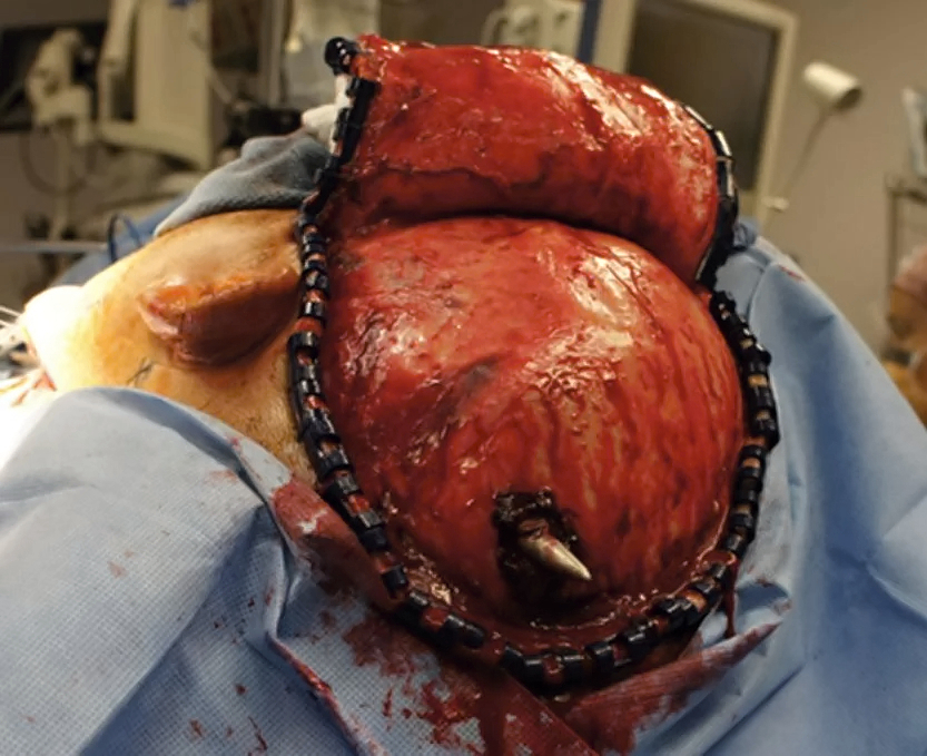 Self inflicted speargun injury to head