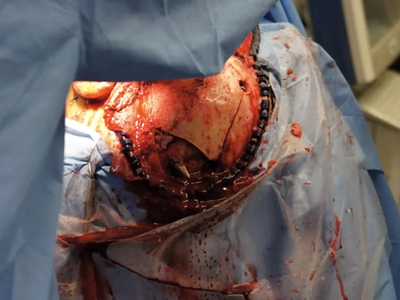 Self inflicted speargun injury to head