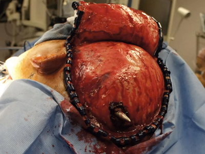 Self inflicted speargun injury to head