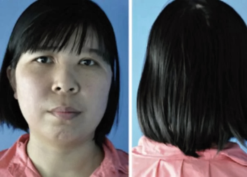 Repair of total scalp avulsion