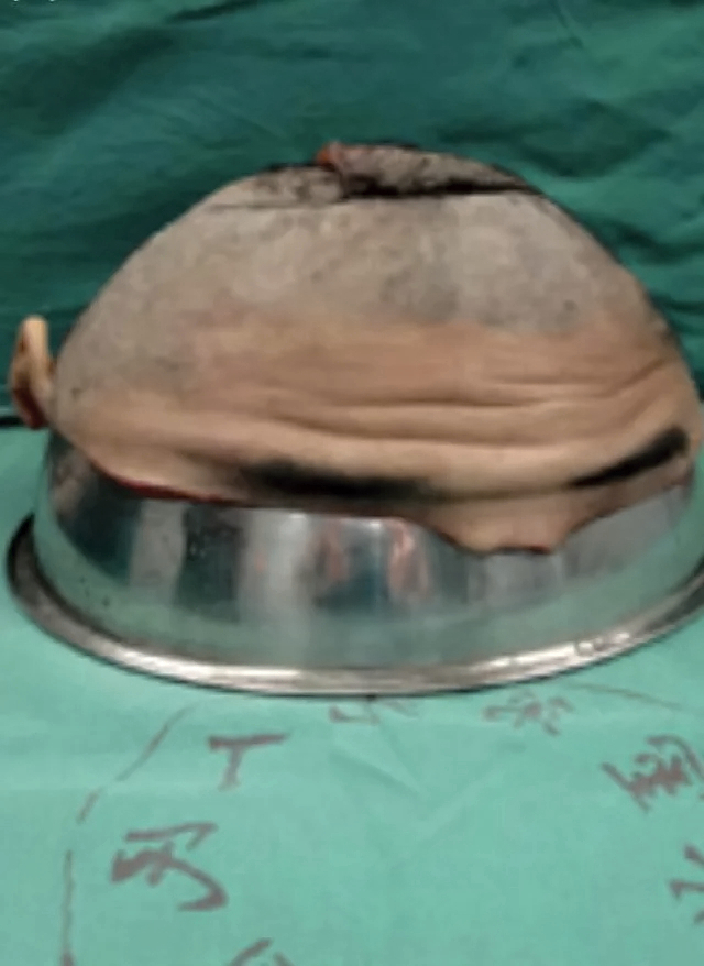 Repair of total scalp avulsion