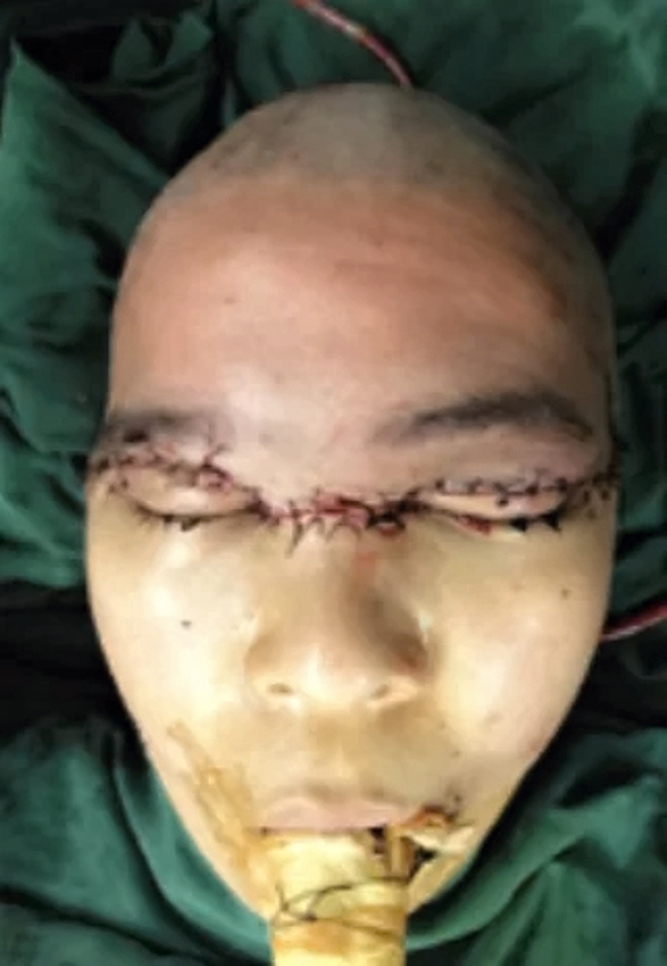 Repair of total scalp avulsion