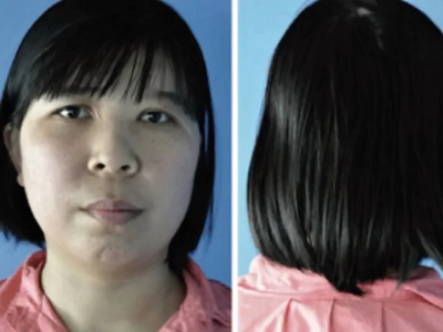 Repair of total scalp avulsion