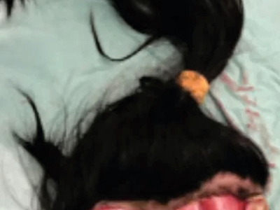 Repair of total scalp avulsion