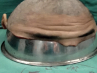 Repair of total scalp avulsion