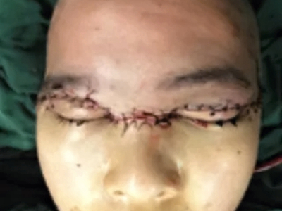 Repair of total scalp avulsion