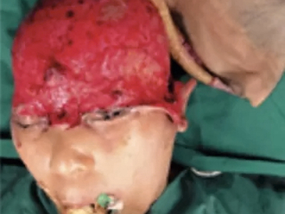 Repair of total scalp avulsion