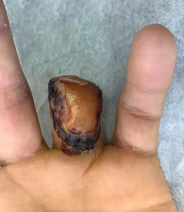 Ring avulsion and degloving injury
