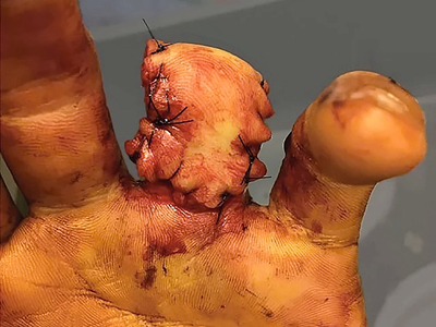 Ring avulsion and degloving injury