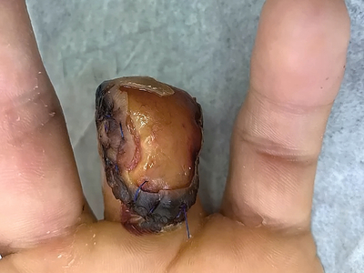 Ring avulsion and degloving injury