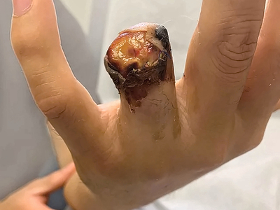 Ring avulsion and degloving injury