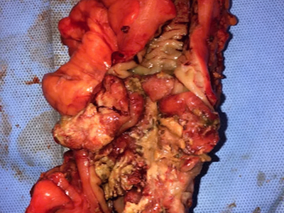 Necrotizing soft tissue infection