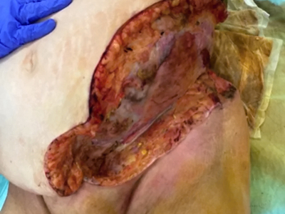 Necrotizing soft tissue infection