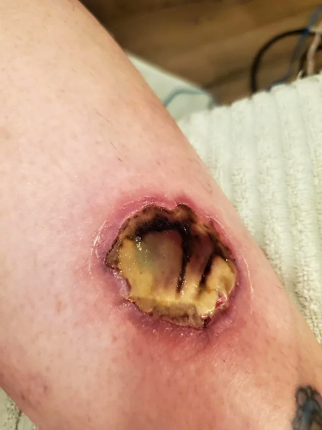 HotHands Burn-Day 1 to Week 5