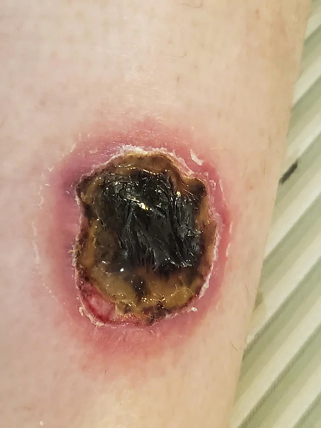 HotHands Burn-Day 1 to Week 5