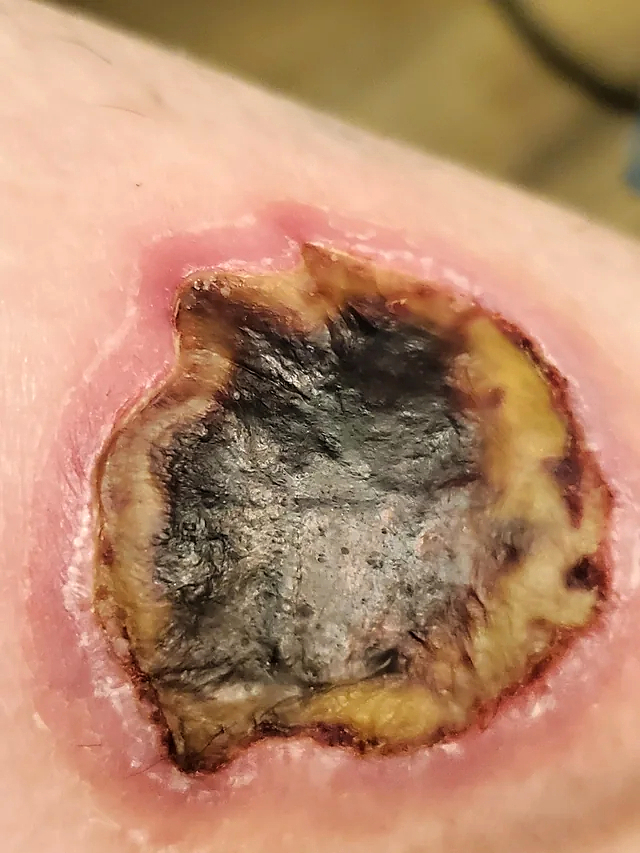 HotHands Burn-Day 1 to Week 5