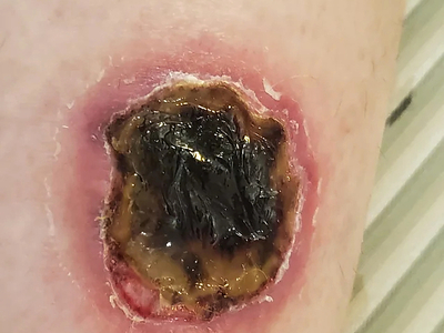 HotHands Burn-Day 1 to Week 5