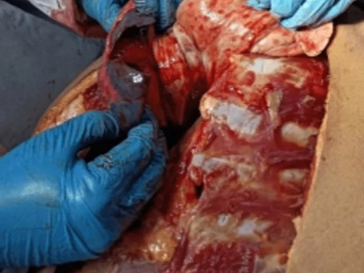 Post-obstructive pulmonary edema in delayed death by hanging