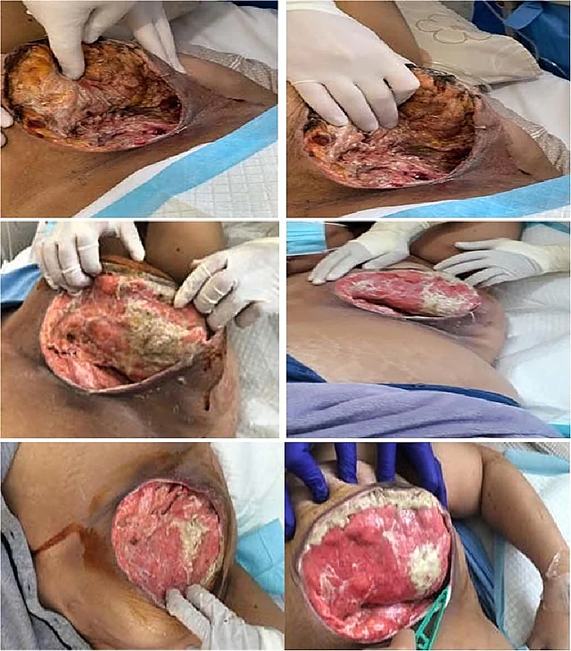 Necrotizing fasciitis of the breast